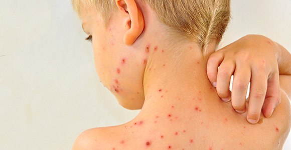 County health department counts the costs of recent measles outbreak