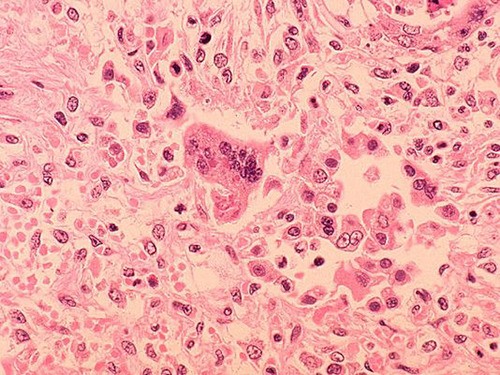 Second case of measles found in Clallam County is 5-year-old child